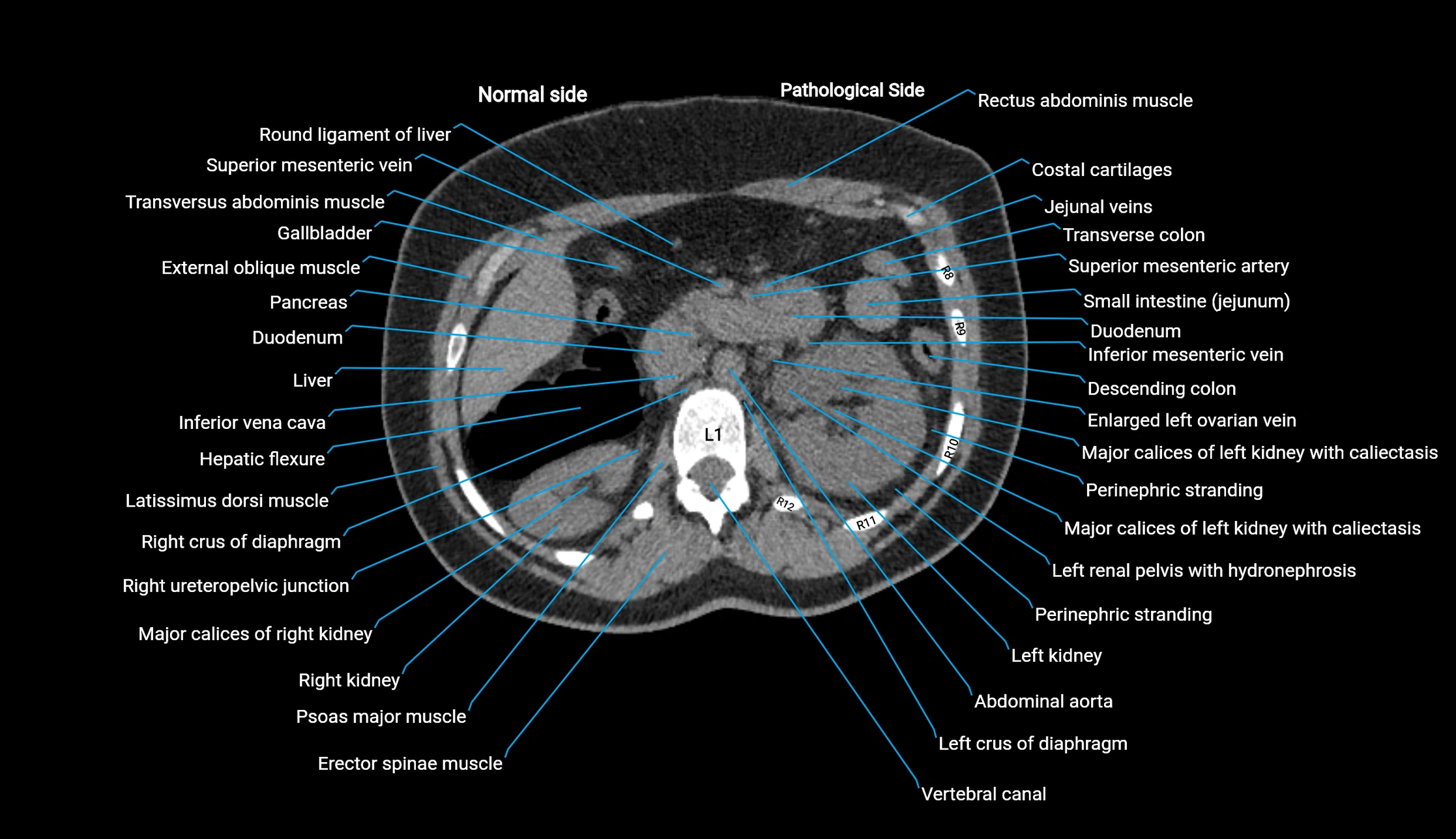 CT KUB axial cross sectional anatomy  radiology image -img-00201-00041.webp